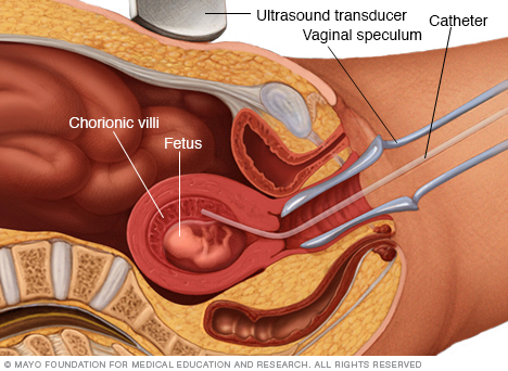 chorionic Villus sampling