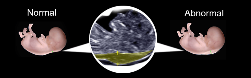 nuchal translucency ultrasound