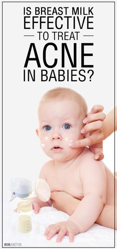 breast milk treats baby acne
