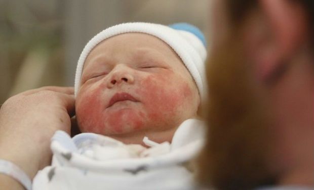 allergies in babies