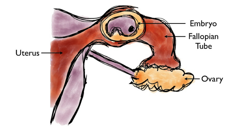 ectopic pregnancy