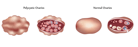 polycystic ovaries