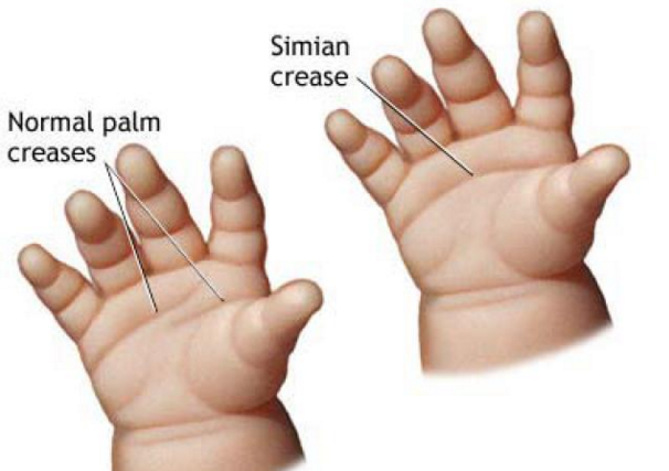 simian crease