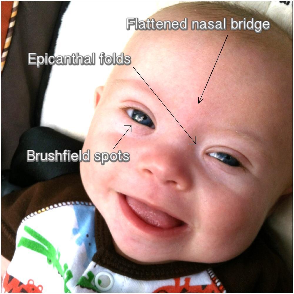 physical features of down syndrome