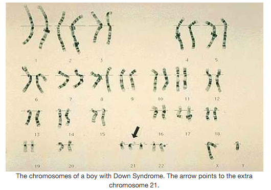 trisomy 21