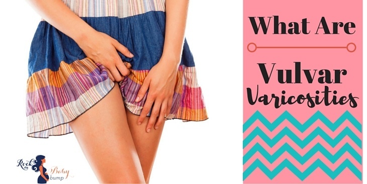 Vulvar Varicosities In Women
