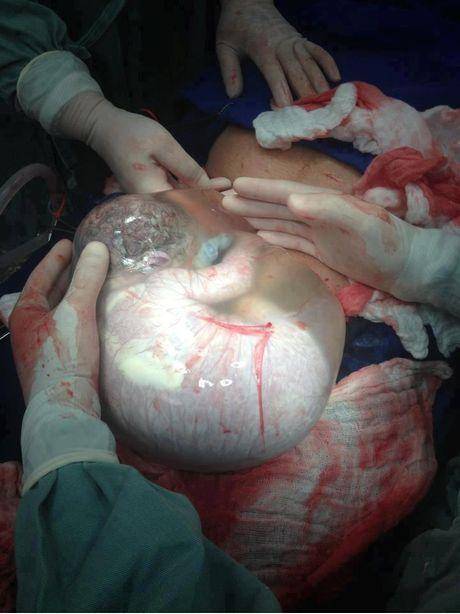 amniotic fluid from c section baby