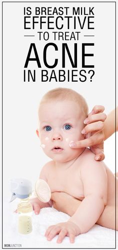 breast milk treats baby acne